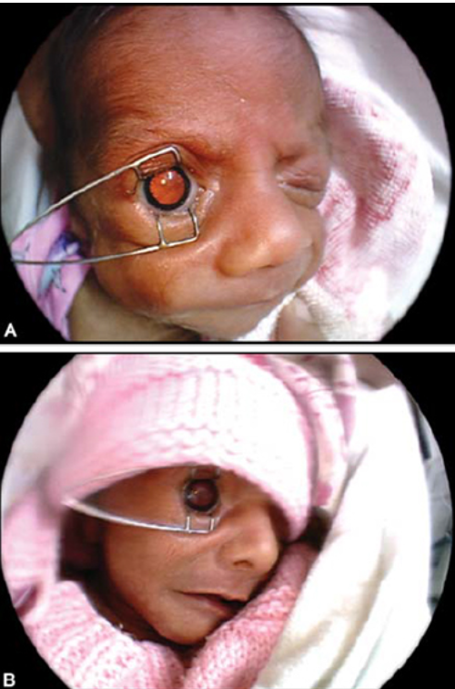 Two clinical images of a premature newborn undergoing an eye examination, showing the use of an eyelid speculum to keep the eye open while the retina is examined for retinopathy of prematurity (ROP).