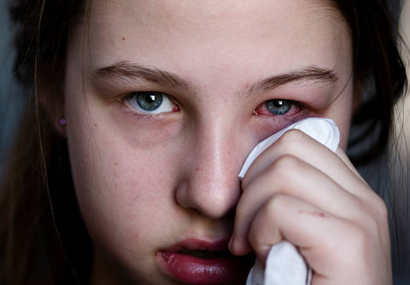 Close up image showing red eye with watering and irritation. Common symptoms seen in conjunctivitis, eye allergy, viral infection and dry eye syndrome. Red eye infection with watering and irritation conjunctivitis symptom