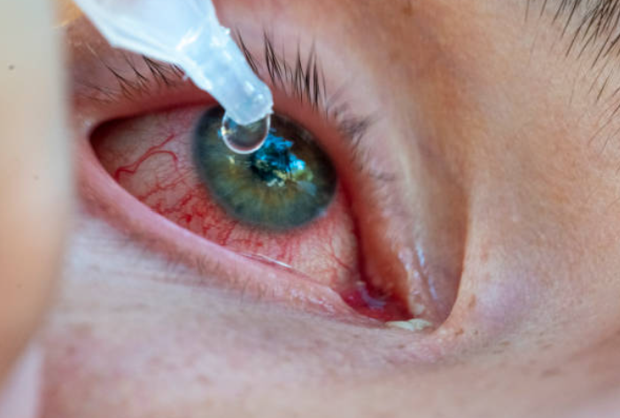 Eye drops are used to treat conjunctivitis, redness, allergy and dry eye symptoms Close up red eye conjunctivitis treatment using eye drops