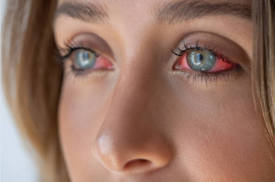 Red eye conjunctivitis infection with inflamed conjunctiva close up eye disease symptom Close up of red eye due to conjunctivitis with inflamed sclera and irritation